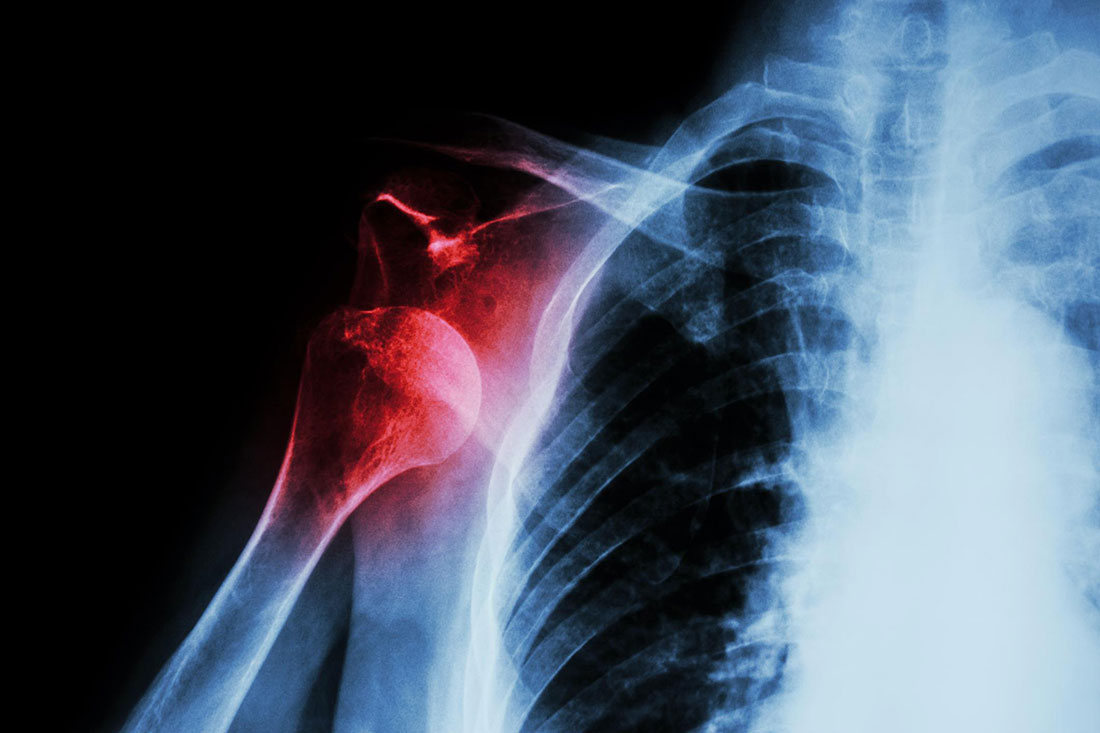 Shoulder Injury At Work? Learn About Your Rights to Workers’ Compensation